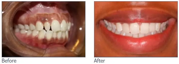Composite Bonding before and after image