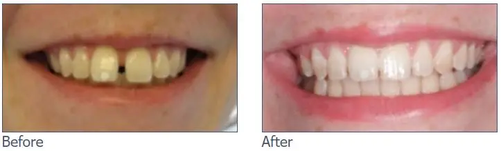 Clear Aligners
