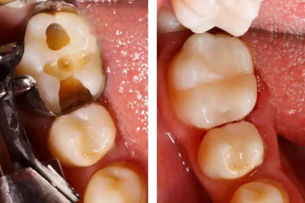 dental filling before and after comparison image
