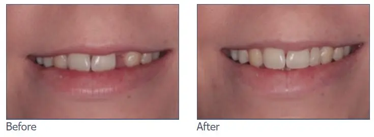 Composite Bonding before and after image
