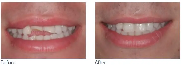Composite Bonding before and after image