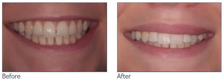 Composite Bonding before and after image