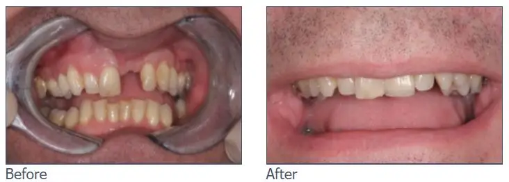Teeth Implants