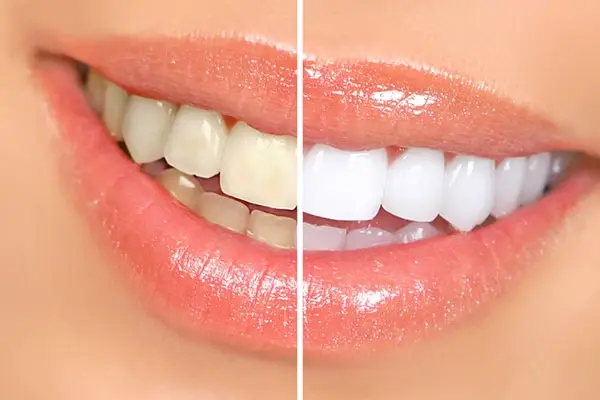 teeth whitening before and after results