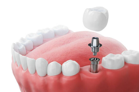 Dental implantation, teeth with implant screw, 3d illustration.