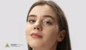 woman with dark under-eye shadows showing tear trough hollowness before filler treatment in London