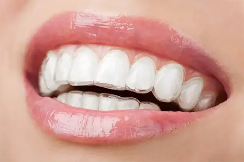 dental Invisalign