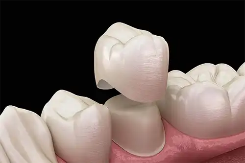 dental crowns