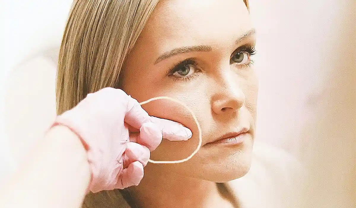 marked the area for Cheek Filler treatment
