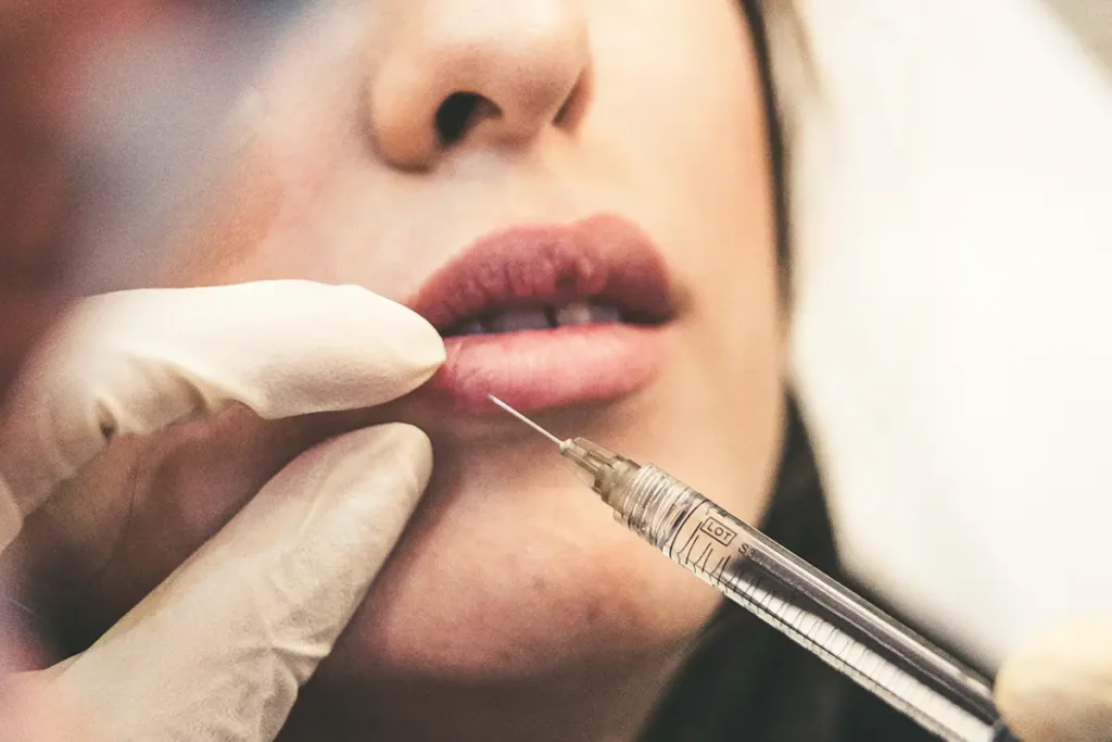 Lip Fillers treatment