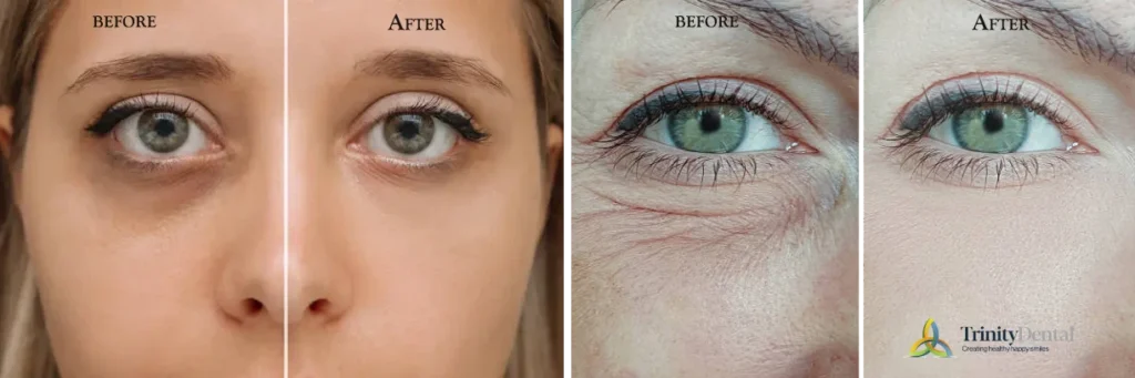 Understanding Outcomes of Before and After under eye filler Treatment