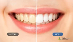 Yellow teeth comparison showing before and after dental whitening results highlighting improved smile brightness