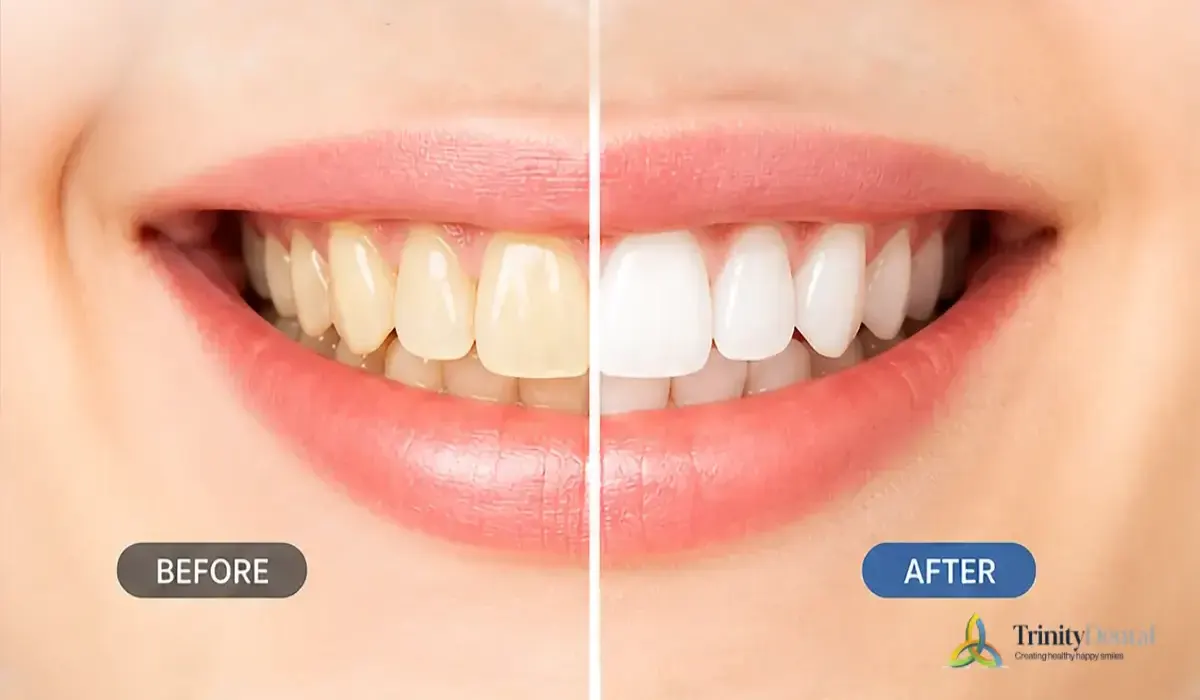 Yellow teeth comparison showing before and after dental whitening results highlighting improved smile brightness