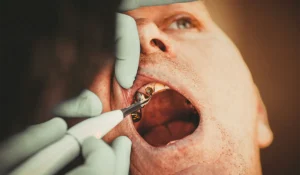 Patient getting dental cavity filling treatment
